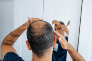 Man examining hair loss in mirror concerned about TRT side effects